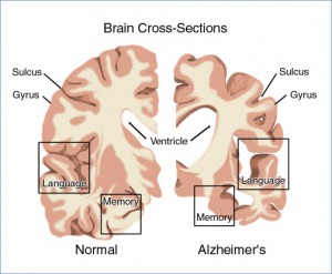 alzheimers-disease3